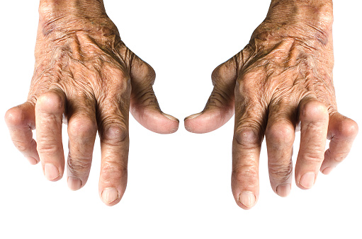 RHEUMATOID ARTHRITIS