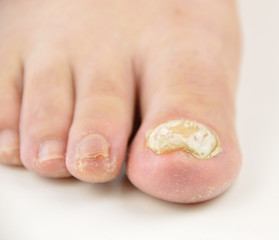 Fungal Infections – Ringworm / Athlete’s foot (day 2)